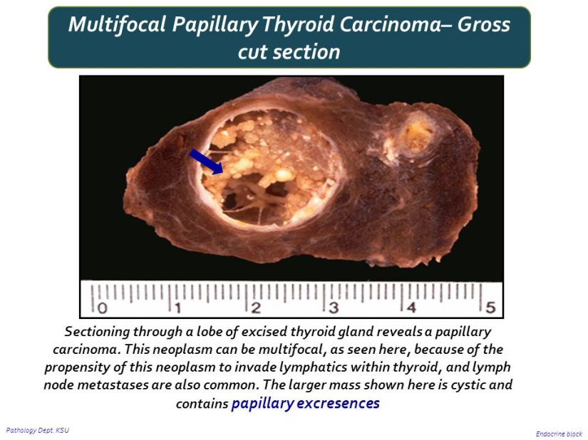 Multifocal+Papillary+Thyroid+Carcinoma–+Gross+cut+section.jpg