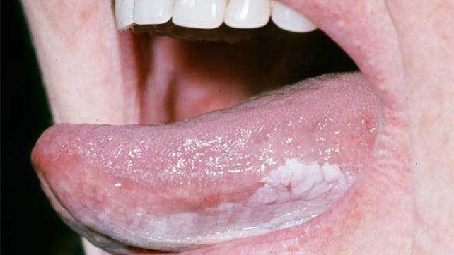 4377-Everything_You_Need_to_Know_About_Tongue_Cancer-642x361-oral_leukoplakia-slide1