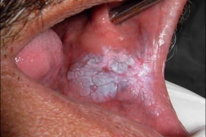 A-Homogenous-Oral-Leukoplakia