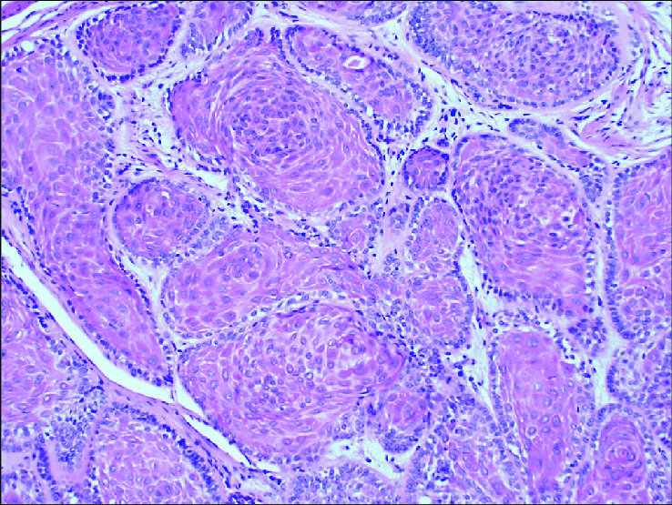 acanthomatous-ameloblastoma-There-central-cells-show-more-mature-squamous