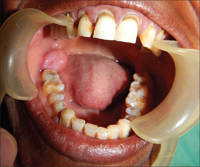 AnnMaxillofacSurg_2016_6_2_304_200349_f1