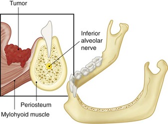 Pathway by which oral cancers invade the mandible