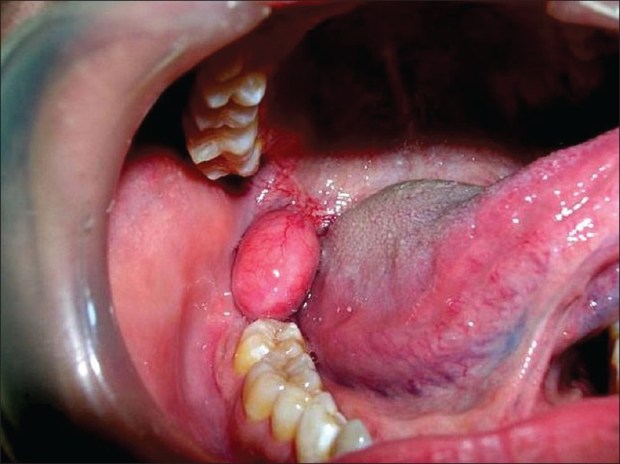 NatlJMaxillofacSurg_2013_4_2_245_127662_f2