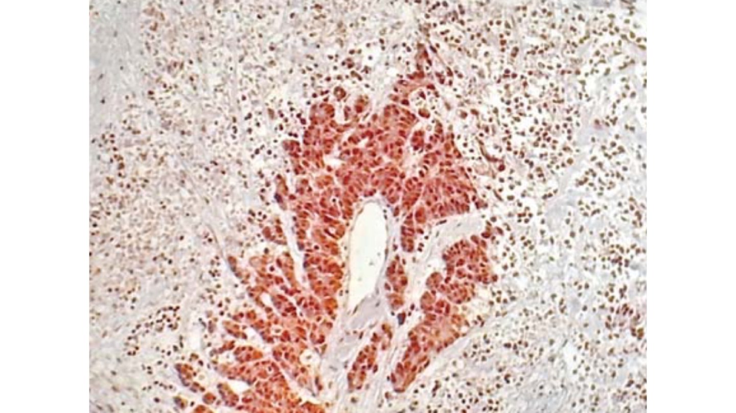 Mucinous Carcinoma (Colloid Carcinoma) of the Breast – Rodrigo ...