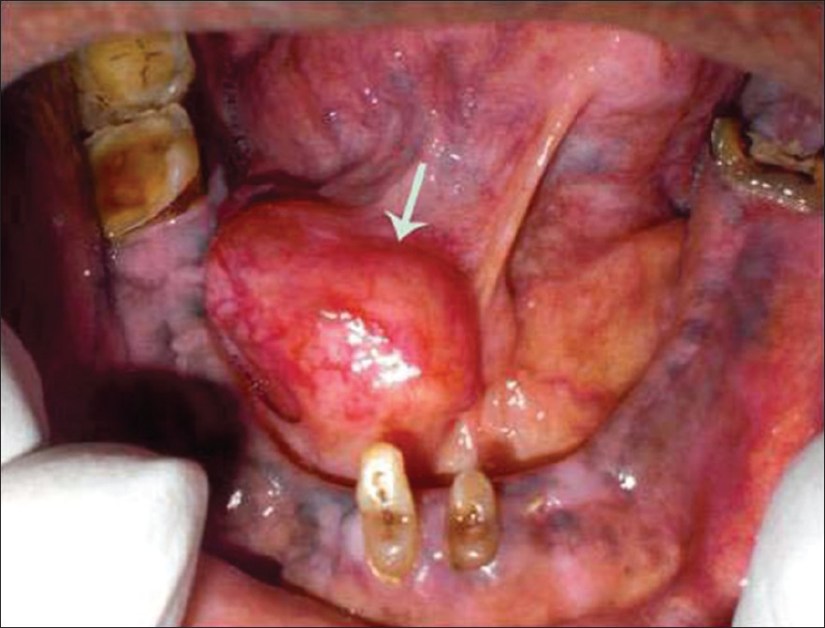 JClinImagingSci_2013_3_2_10_120793_u1