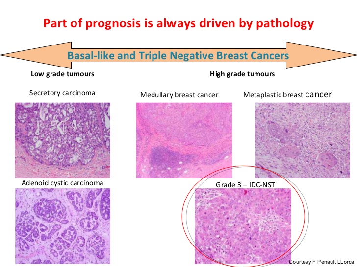 mco-2011-slide-12-j-gligorov-spotlight-session-triple-negative-breast-cancer-an-overview-23-728