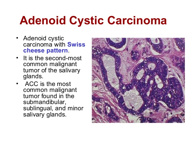 salivary-gland-pathology-23-638