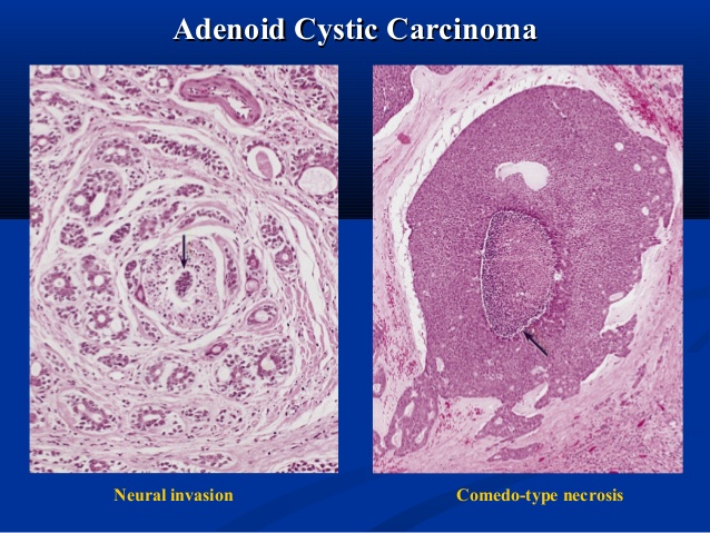 Adenoid Cystic Carcinoma (ACC) – Rodrigo Arrangoiz MS, MD, FACS, FSSO