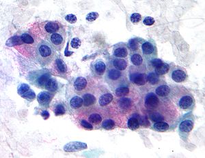 300px-mucoepidermoid_carcinoma_2_-_very_high_mag