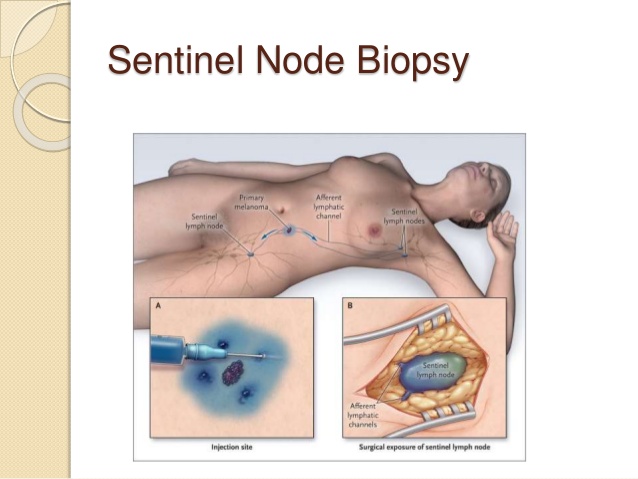 cancer-of-the-vulva-38-638