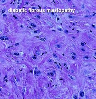 diabetic-fibrous-mastopathy-blue