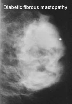 diabetic-fibrous-mastopathy-breast-xray