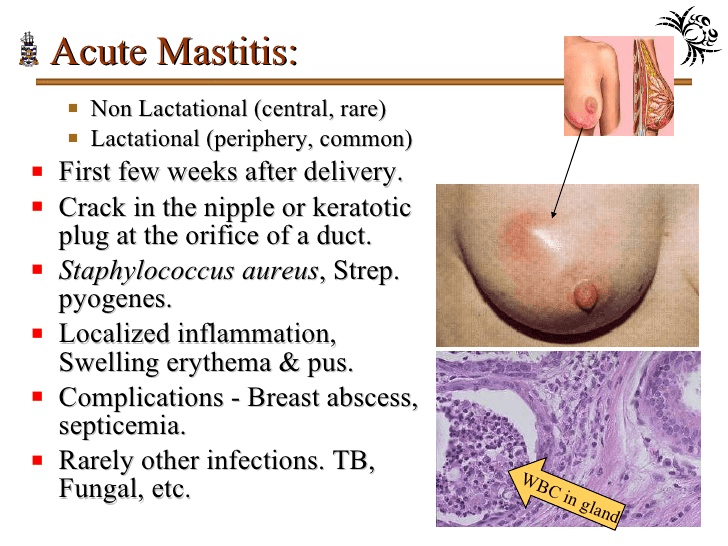 mastistis