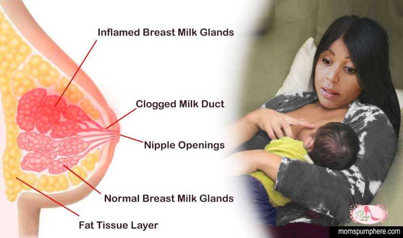 mastitis-breastfeeding-diagram