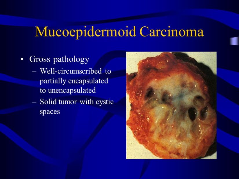 mucoepidermoid+carcinoma-1