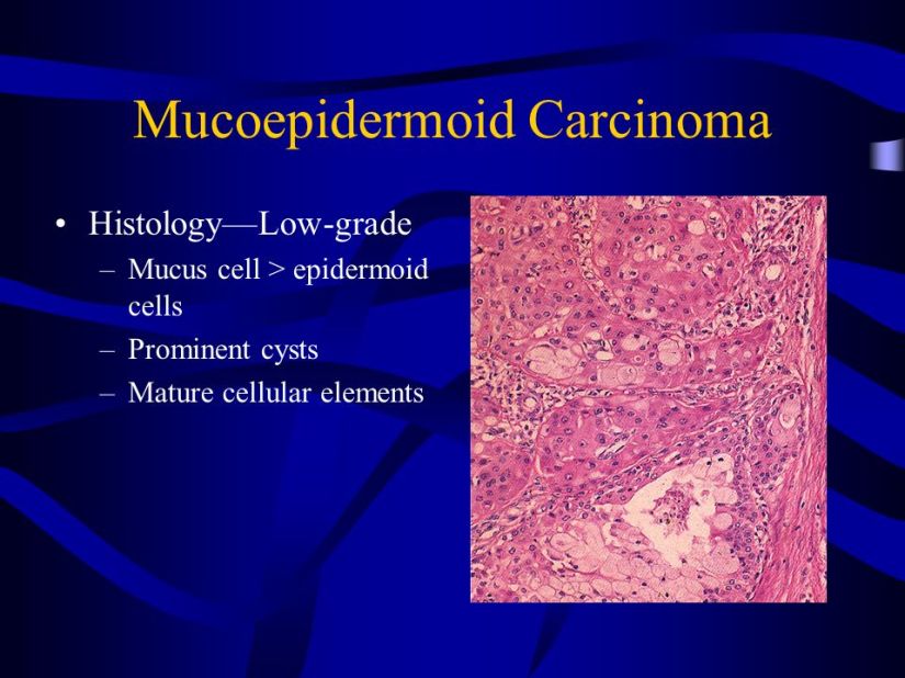 mucoepidermoid+carcinoma