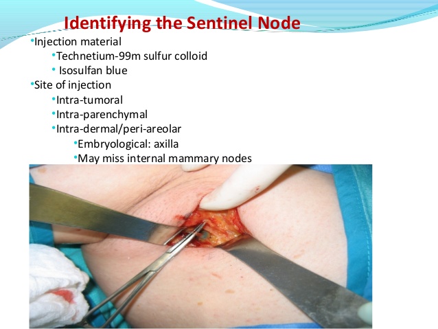 sentinel-lymph-node-concept-in-early-breast-cancer-by-prof-r-wasike-19-638
