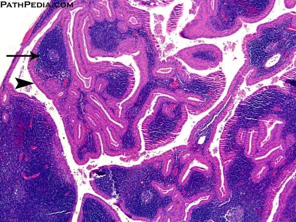 warthin-tumor-parotid-[1-pa003-1]