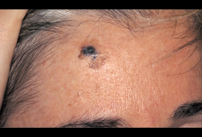 FCASCD_desmoplastic_melanoma