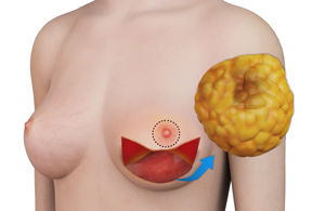 nipple-sparing-mastectomy