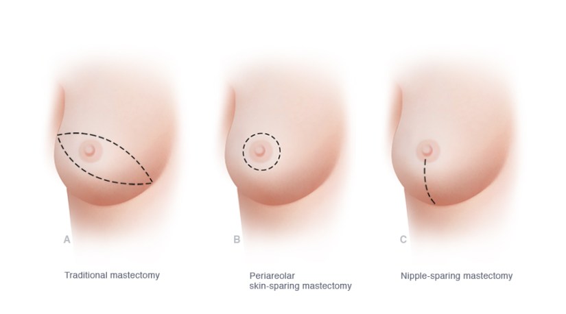 popup-mastectomy_lg