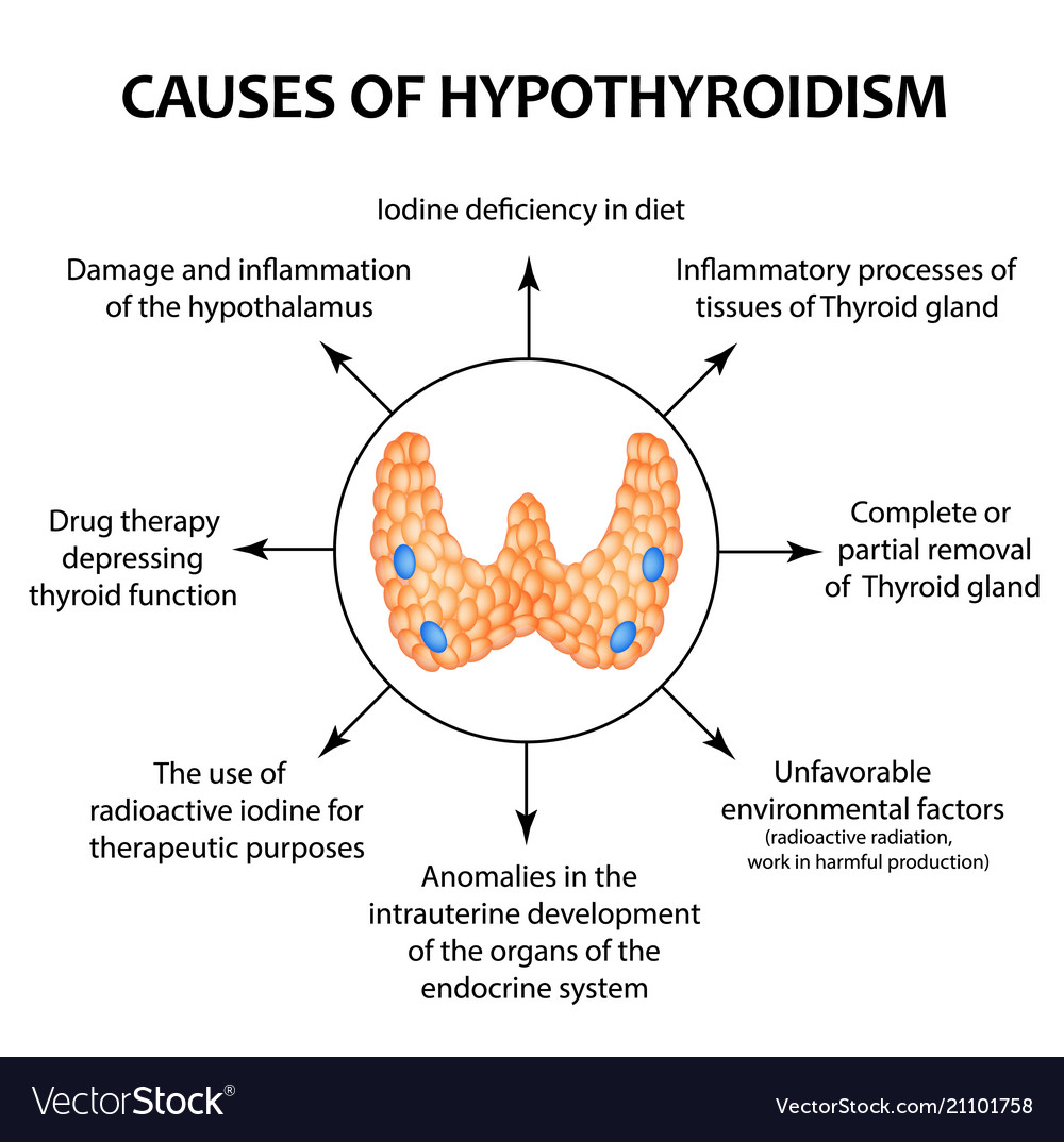The causes of thyroid hypothyroidism. Infographics. Vector illustration on isolated background.