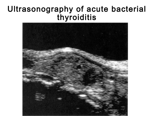 thyroiditis-by-dr-selim-14-638