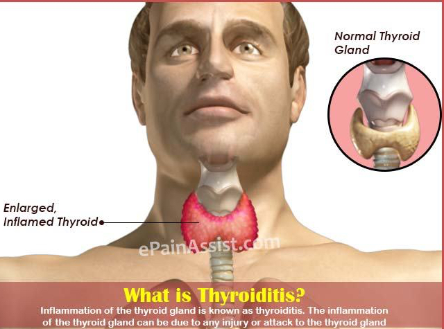 what-thyroiditis