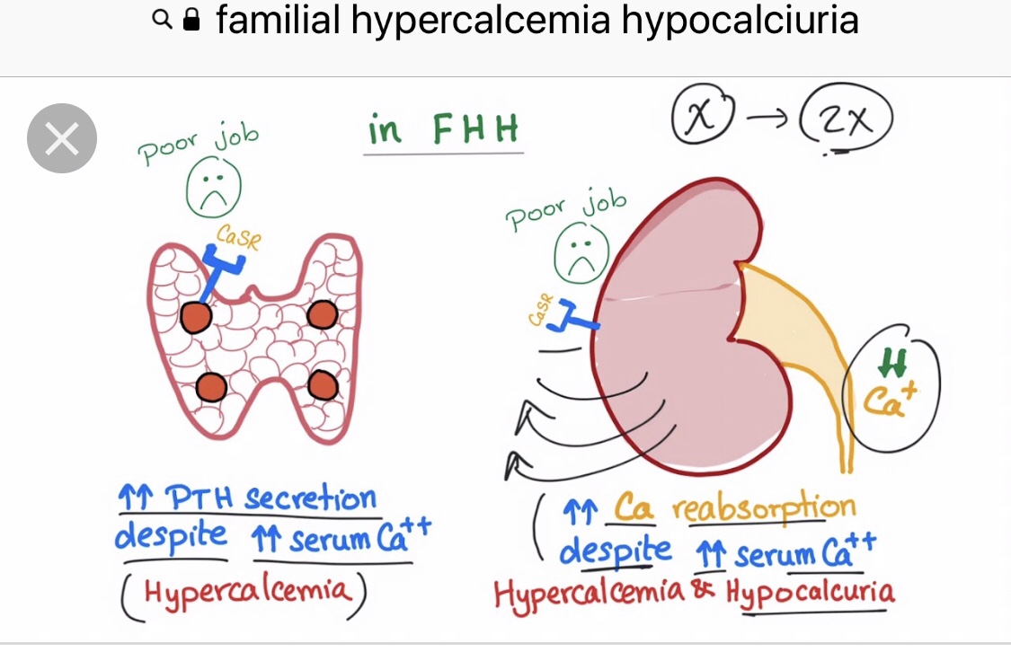 Summary of Primary Hyperparathyroidism (PHPT) – Rodrigo Arrangoiz MS ...