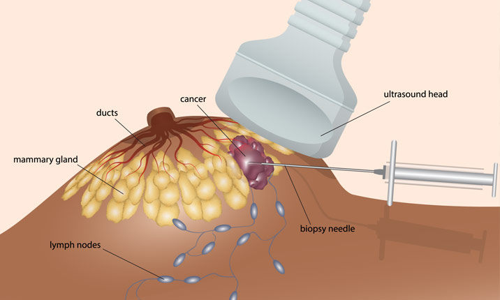 biopsy-types-breast