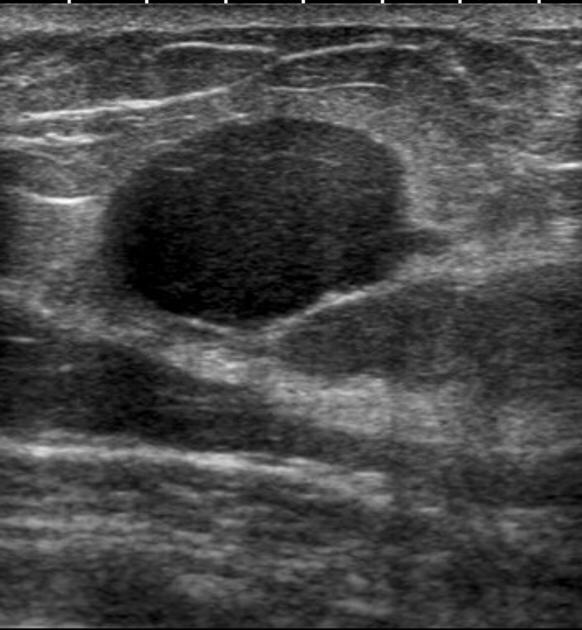 Papillary Breast Lesions – Rodrigo Arrangoiz MS, MD, FACS, FSSO