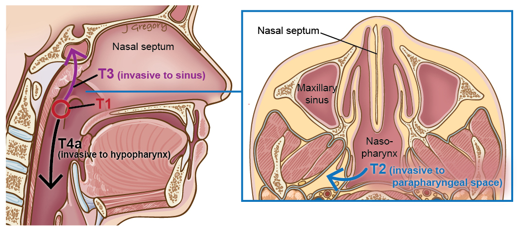 41_1_tonsil