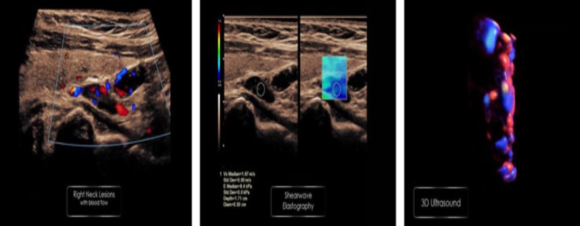 Parathyroid Adenoma Ultrasound