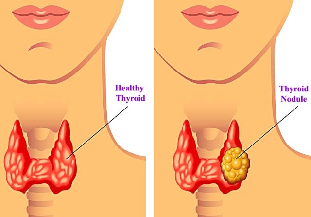 What is a Thyroid Nodule? – Rodrigo Arrangoiz MS, MD, FACS, FSSO