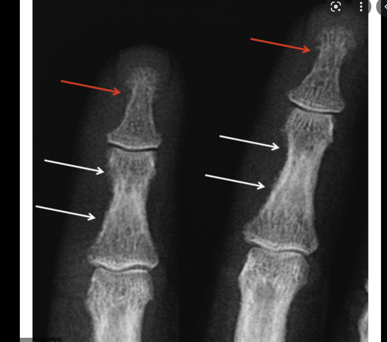 Skeletal Manifestations of Primary Hyperparathyroidism (PHPT) – Rodrigo ...
