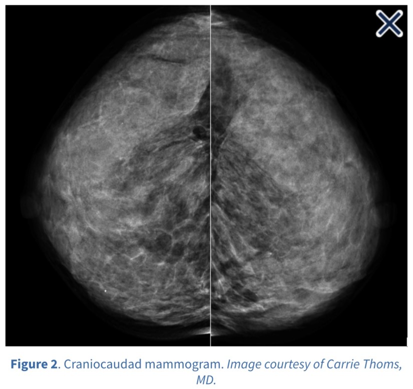 Mammogram with Tomosynthesis for Dense Breast – Rodrigo Arrangoiz MS ...