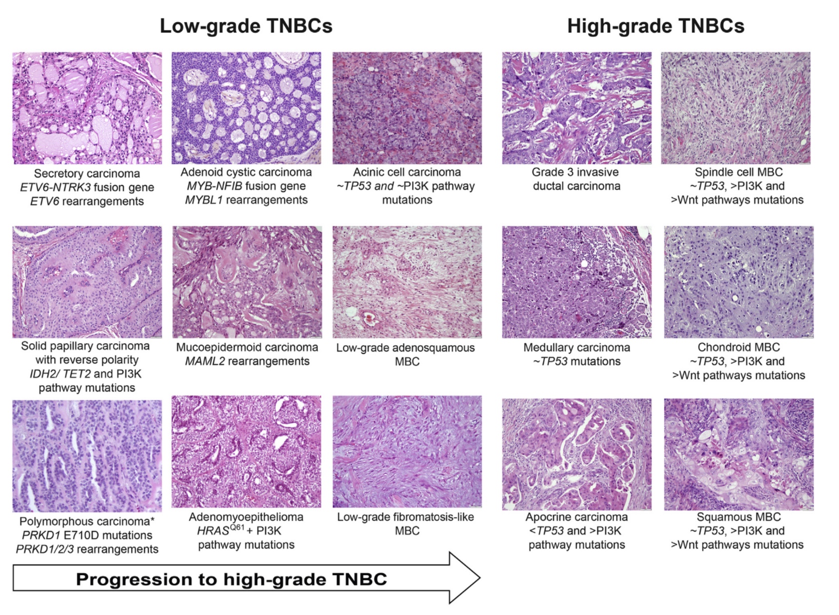 Pathology of Triple Negative Breast Cancer Part 1 – Rodrigo Arrangoiz ...