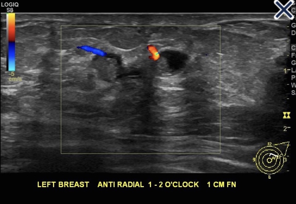 Papillary Lesions of the Breast – Rodrigo Arrangoiz MS, MD, FACS, FSSO