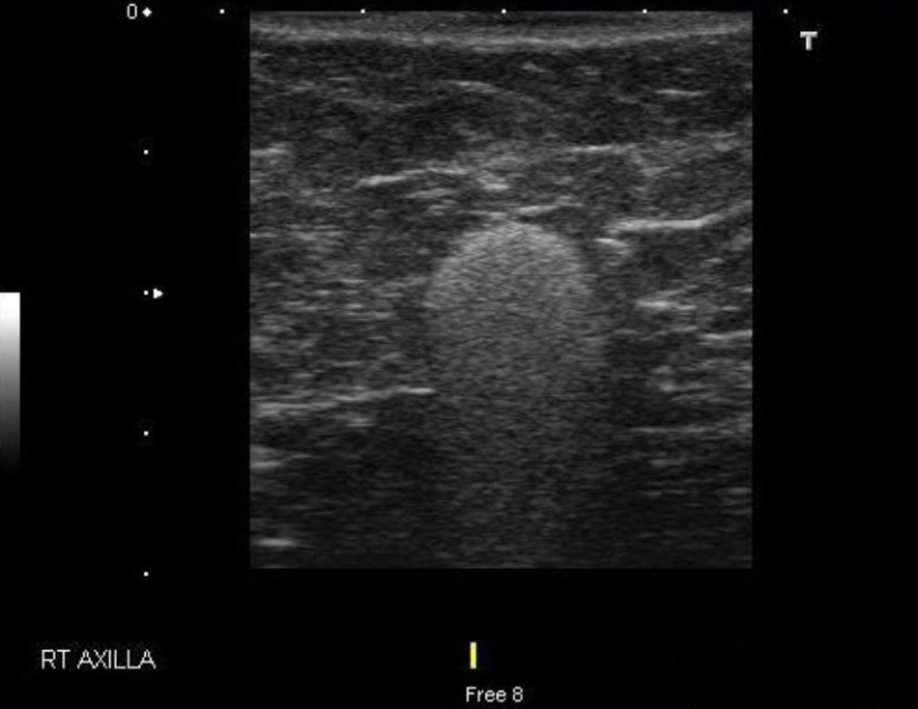 Sonographic Appearance of Lymph Nodes – Rodrigo Arrangoiz MS, MD, FACS ...