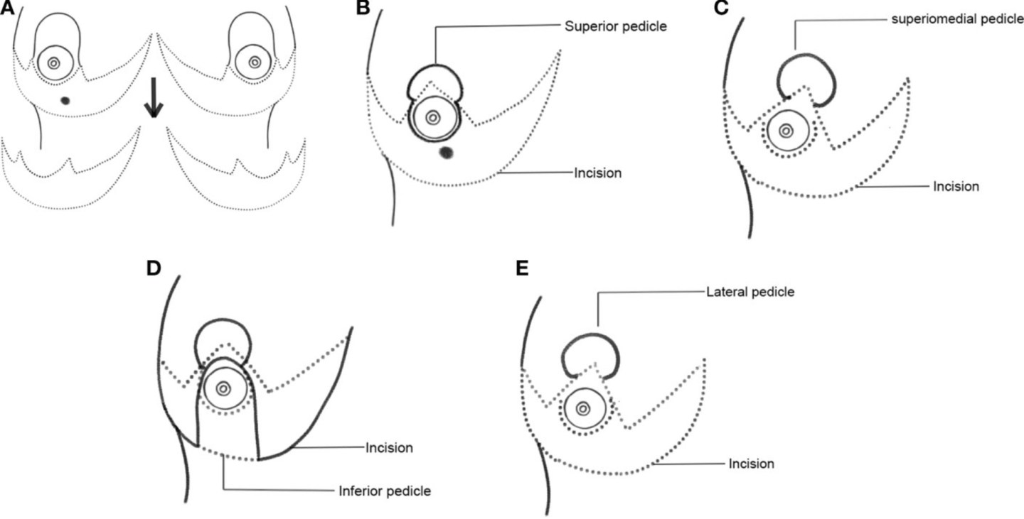 Anchor Incision Pattern Breast Oncoplastic Incisions – Rodrigo Arrangoiz MS, MD, FACS, FSSO