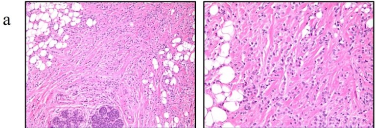 Systemic Treatment of Invasive Lobular Breast Cancer Part 1 – Rodrigo ...