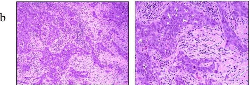 Systemic Treatment of Invasive Lobular Breast Cancer Part 1 – Rodrigo ...