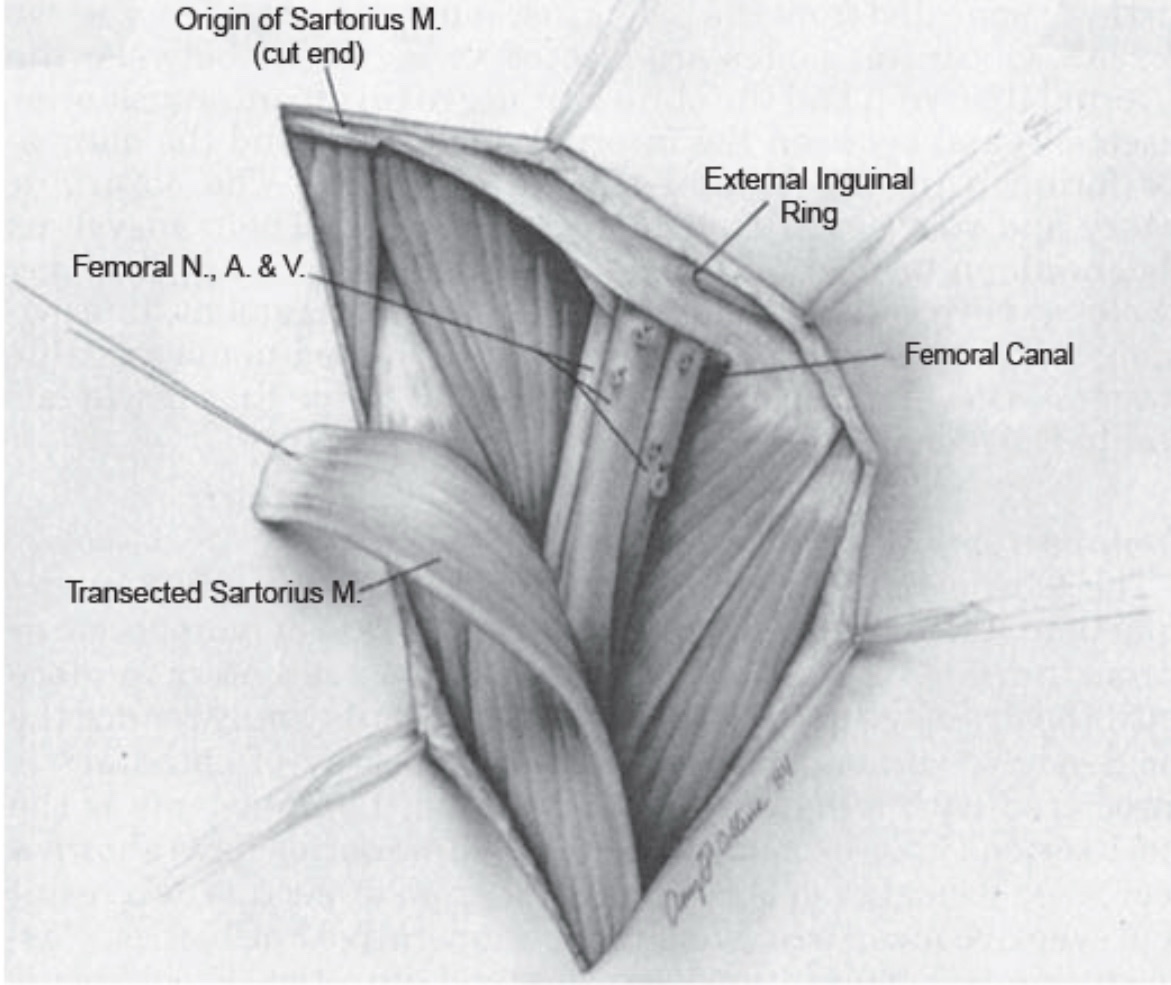 Superficial (Inguinal) Groin Dissection for Melanoma – Rodrigo ...