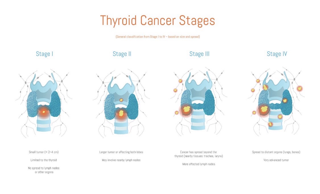 Thyroid Awareness Month – Poorly Differentiated Thyroid Cancer (PDTC ...